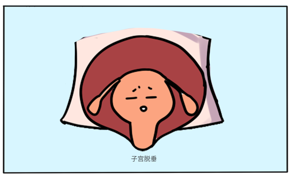 腹直肌分离5.png