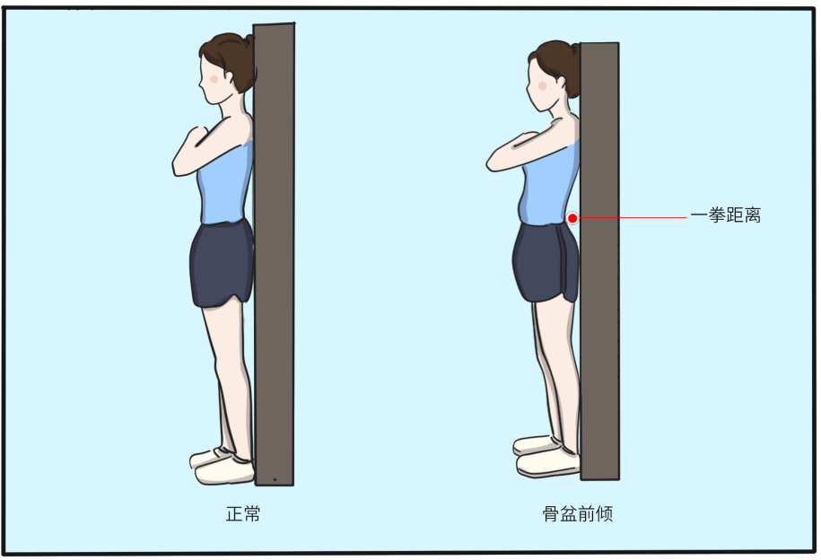 腹直肌分离6.png
