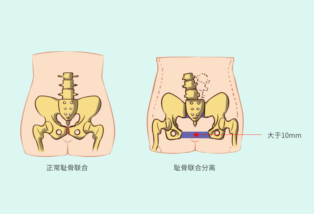 耻骨联合2.png