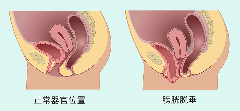 盆腔脏器脱垂2.png