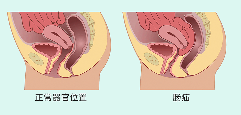 盆腔脏器脱垂6.png